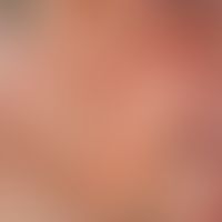 Thomson's syndrome. Pale red spotted skin with reticulated telangiectasia on the right cheek of a...