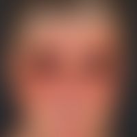 Thomson-Syndrom:&nbsp;beidseitige Rarefizierung der Augenbrauen und Augenwimpern bei einer 59-jäh...