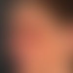 Thomson's syndrome. Lateral view of a 59-year-old female patient with Thomson's syndrome. Catarac...