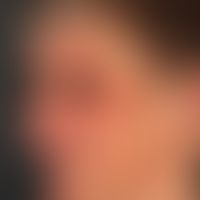 Thomson's syndrome. Lateral view of a 59-year-old female patient with Thomson's syndrome. Catarac...