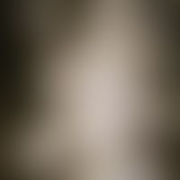 Pityriasis amiantacea. solitary, chronically active plaque affecting the entire hairy area of the...