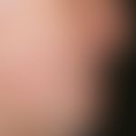 Tinea barbae. scaly, blurred, itchy erythema (incipient plaques) on the cheek and upper lip. eryt...