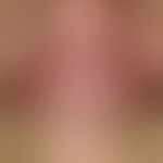 tinea barbae. 64-year-old patient. 12 weeks of itching to moderately painful, well defined, pillo...