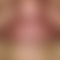 tinea barbae. 64-year-old patient. 12 weeks of itching to moderately painful, well defined, pillo...