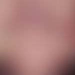 tinea barbae. high red, itchy and also aching plaque, existing for several months, blurred on the...