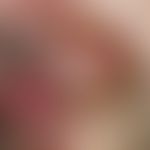 Tinea barbae. slowly growing, only moderately painful lump that has been present for several mont...
