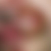 Tinea barbae. slowly growing, only moderately painful lump that has been present for several mont...