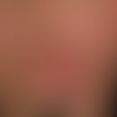 Tinea barbae: seit mehreren Wochen umschrieben, juckende und schuppende Plaques mit einzelnen fol...