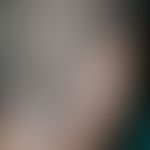 Tinea capitis:&nbsp;ausgedehnte nicht vorbehandele Infektion der behaarten und unbehaarten Kopfha...