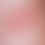 Tinea corporis:&nbsp;Randbetonter, konzentrisch angeordneter, peripher fortschreitender, mäßig ju...