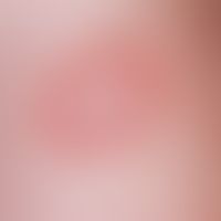 Tinea corporis: peripheral, peripherally progressive, moderately itchy, concentric focus with fin...