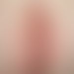Tinea corporis. Akute, intergluteal lokalisierte, symmetrisch angeordnete, flächige, ovale, am Ra...