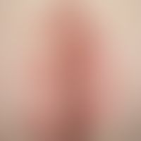 Tinea corporis. Akute, intergluteal lokalisierte, symmetrisch angeordnete, flächige, ovale, am Ra...