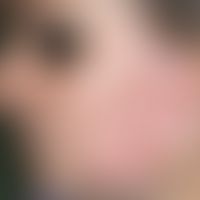 Lupus erythematodes chronicus discoides. Seit 15 Jahren persistierende, trotz krankheitsadaptiert...