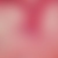 Lupus erythematosus chronicus discoides, follicular hyperkeratosis, histological correlation to t...