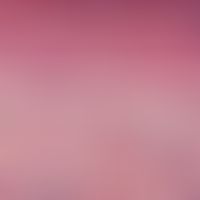 Lupus erythematodes chronicus discoides, detail enlargement: Hydropic degeneration in the stratum...