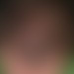Lupus erythematodes chronicus discoides. Übersichtsaufnahme: Seit mehreren Jahren persistierende,...