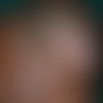 Lupus erythematodes chronicus discoides: tief vernarbender&nbsp;zum Follikelverlust führender dis...