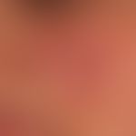 Lupus erythematodes chronicus discoides. Solitäre unscharf begrenzte Plaque mit atropischer Oberf...