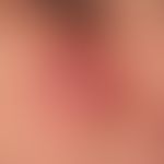 Lupus erythematodes chronicus discoides: seit 4 Monaten bestehende, 2,7x3,2 cm große, sukkulente,...