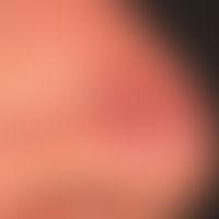Lupus erythematodes chronicus discoides: Befall des Nasenrückens. Detailabbildung.
