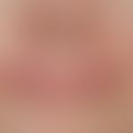 Chronische Cheilitis bei Lupus erythematodes chronicus discoides. Chronisch aktive, rote, hyperäs...