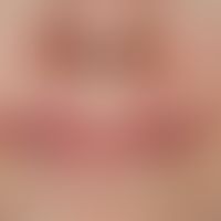 Chronische Cheilitis bei Lupus erythematodes chronicus discoides. Chronisch aktive, rote, hyperäs...