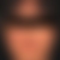 Lupus erythematodes chronicus discoides. Chronische mäßig indurierte Plaques, randlich mit entzue...