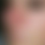Tinea faciei. Multiple, chronisch aktive, seit 4 Wochen flächig wachsende, disseminierte, 0,5-3,0...