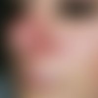 Tinea faciei. Multiple, chronisch aktive, seit 4 Wochen flächig wachsende, disseminierte, 0,5-3,0...