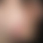 Tinea faciei. Multiple (wenige), chronisch aktive, seit 8 Wochen flächig wachsende, disseminierte...