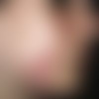 Tinea faciei. Multiple (wenige), chronisch aktive, seit 8 Wochen flächig wachsende, disseminierte...