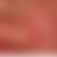 Zoophile Tinea faciei: Detailaufnahme
