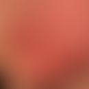 Tinea faciei: 7 Wochen zuvor wurde ein Streichelzoo besucht.&nbsp;Großflächige, zirzinäre randbet...
