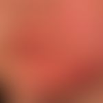 Tinea faciei: 7 Wochen zuvor wurde ein Streichelzoo besucht.&nbsp;Großflächige, zirzinäre randbet...