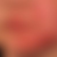 Tinea faciei: 7 Wochen zuvor wurde ein Streichelzoo besucht.&nbsp;Großflächige, zirzinäre randbet...