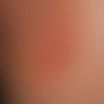 Tinea inguinalis. Handtellergroßer, gelb-bräunlicher Herd mit entzündlichen, follikulär gebundene...