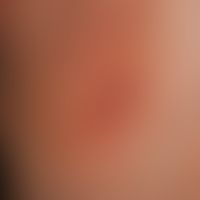 Tinea inguinalis. Handtellergroßer, gelb-bräunlicher Herd mit entzündlichen, follikulär gebundene...