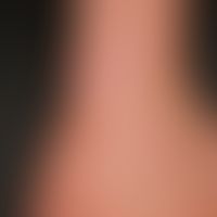 Tinea manuum. Flache, randbetonte, wenig schuppende Herde mit einzelnen follikulären Papeln im Be...