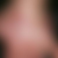 Tinea manuum. Flache, randbetonte, raue (wenig schuppende), gering prominente Papeln und Plaques ...