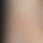Tinea pedum. general view: Discrete, well-defined, heart-shaped, slightly scaly hyperkeratosis an...