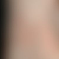 Tinea pedum. general view: Discrete, well-defined, heart-shaped, slightly scaly hyperkeratosis an...