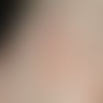 Tinea pedum: discrete, well defined, heart-shaped, slightly scaly erythema and hyperkeratosis on ...