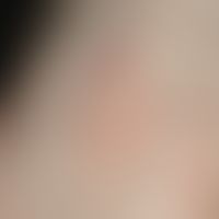 Tinea pedum: discrete, well defined, heart-shaped, slightly scaly erythema and hyperkeratosis on ...