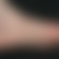 Tinea pedum:Diskrete, gut abgegrenzte, herdförmige, gerötete, leicht schuppende Erytheme und Hype...