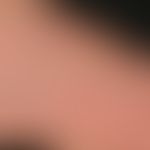 Tinea pedum, detail enlargement: Sharply defined, marginal scaly erythema, pustular formation, sc...