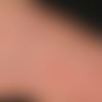 Tinea pedum, detail enlargement: Sharply defined, marginal scaly erythema, pustular formation, sc...