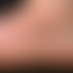 Tinea pedum, detail enlargement: Sharply defined, marginal scaly erythema, pustular formation, sc...