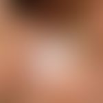 Tinea pedum. macerated, whitish, swollen skin and small erosions in the 1st interdigital space in...