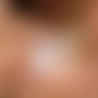 Tinea pedum. macerated, whitish, swollen skin and small erosions in the 1st interdigital space in...